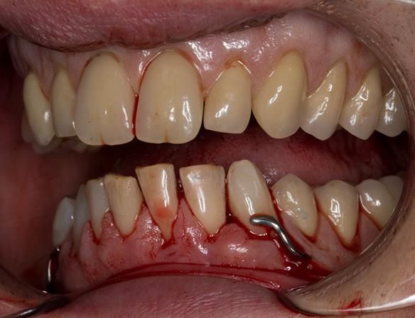 Figure 48 Visit 2 fitting of Mk 1 upper complete and lower partial immediate dentures