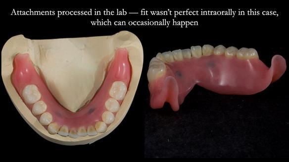 Newsletter 78: What do Clark Gable and a Locator® overdenture have in common?