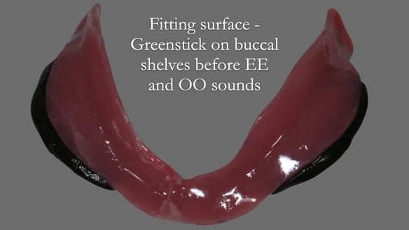 Finlay's Newsletter 62 provision of extractions and metal based complete dentures for Rafique
