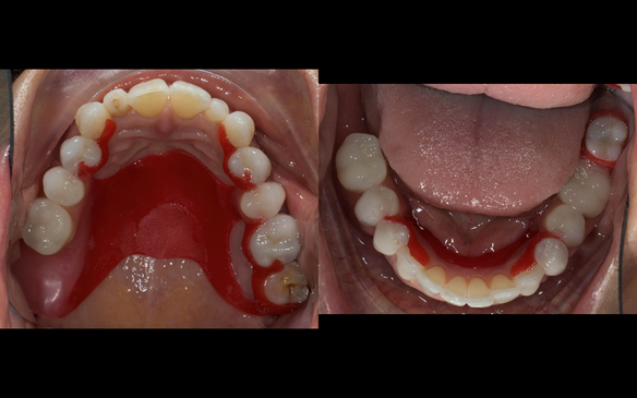 Figure 63 Teeth try in on pattern resin bases in the mouth. These help to confirm the accuracy of the working casts and the amount of metal work which will be visible in the final dentures