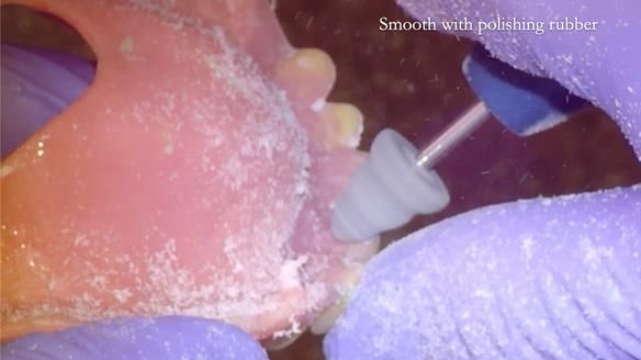 Finlay's Newsletter 62 provision of extractions and metal based complete dentures for Rafique