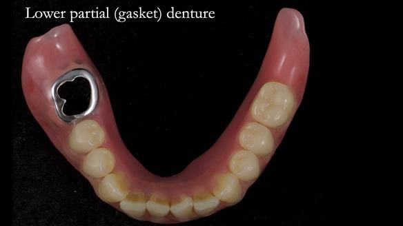 Newsletter 82 Mary - A complete upper and a one-tooth gasket denture
