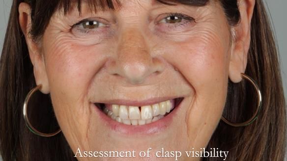 Newsletter 56 showing the making and fitting of a bilateral free end saddle upper removable partial denture (RPD) for patient with pemphigus