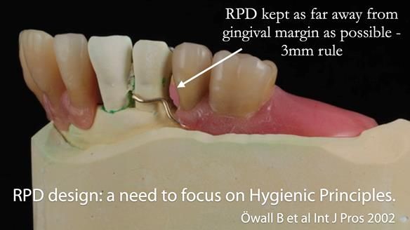 Finlay's Newsletter 59 Ultra hard partial dentures made for Gill