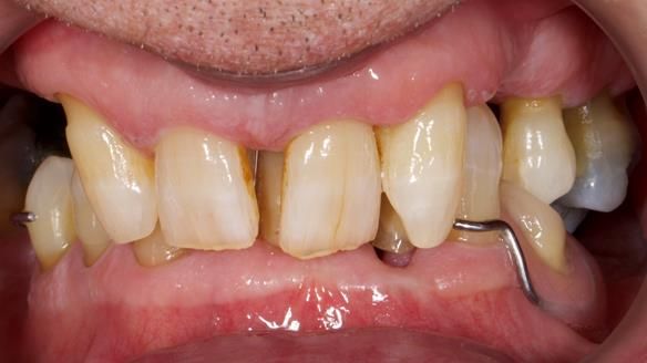 Newsletter 86 Peter the Architect — precision removable partial dentures case study
