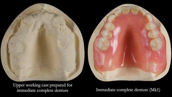 Newsletter 77: Jeremy’s case – immediate complete upper denture