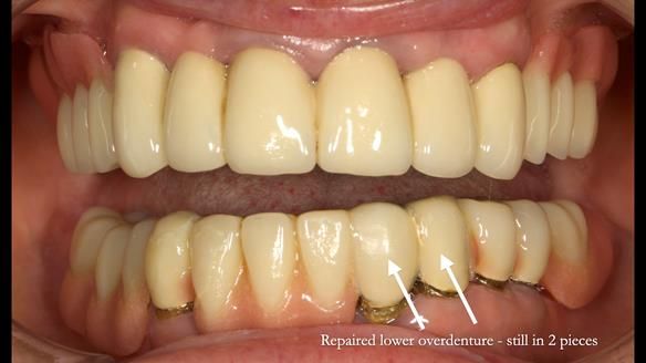 Newsletter 76: Jackie’s case – Telescopic overdenture & precision RPD (the tricky truth!)