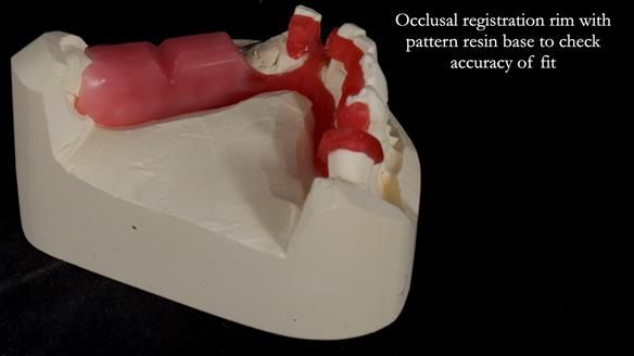 Newsletter 55 Provision of metal based partial dentures for Zephyrine with a repaired cleft lip and palate