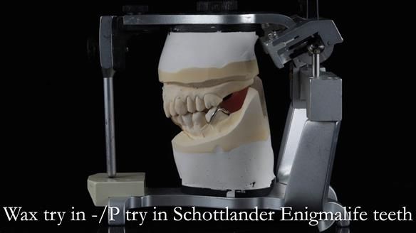 Newsletter 54 case presentation upper complete denture and lower Scandinavian designed hygienic partial denture for David