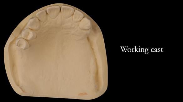 Solving Sue's failed implants with metal based RPD - full protocol Newsletter 43