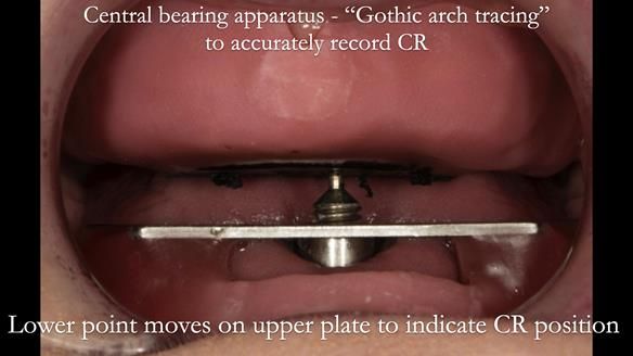 Newsletter 75: Marion’s case - Step-by-step complete denture workflow