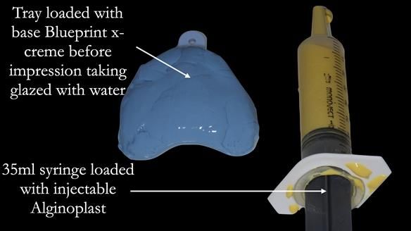 Newsletter 54 case presentation upper complete denture and lower Scandinavian designed hygienic partial denture for David
