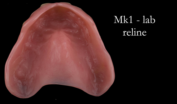 Figure 54 Thinned labial flange of reline - giving improved lip support