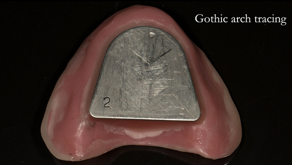 Figure 78 Gothic arch plate on light cure base - before chinagraph pencil application