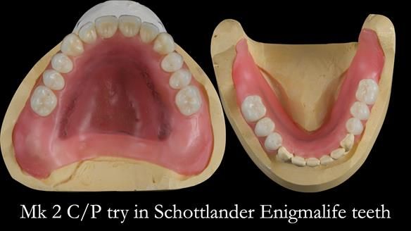 Newsletter 52 Managing Jo’s failing dentition with extractions and Mk 1/Mk 2 complete upper dentures and lower partial dentures FULL PROTOCOL