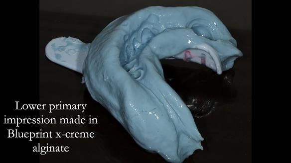 Eileen's transformation with upper and lower RPDs of Scandinavian hygienic design FULL PROTOCOL