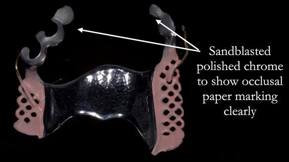 Solving Sue's failed implants with metal based RPD - full protocol Newsletter 43