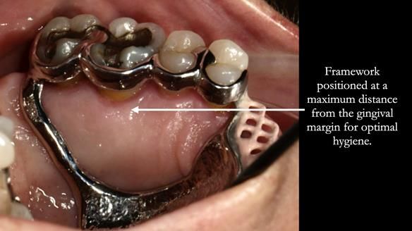 Finlay's Newsletter 63 Case study provision of metal based Scandinavian RPD - functional 10 years on