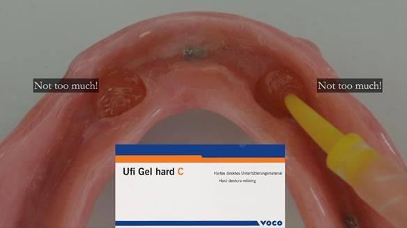 Newsletter 78: What do Clark Gable and a Locator® overdenture have in common?