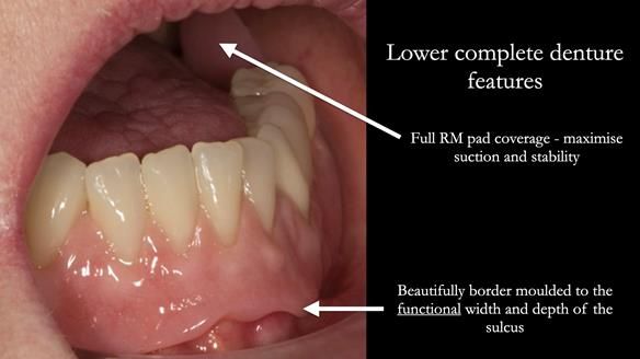 Newsletter 75: Marion’s case - Step-by-step complete denture workflow