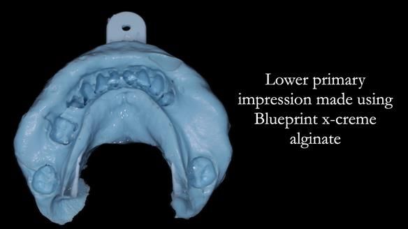Finlay's Newsletter 58 Gasket upper partial denture for Zoe