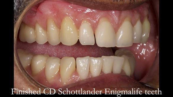 Finlay's Newsletter 62 provision of extractions and metal based complete dentures for Rafique