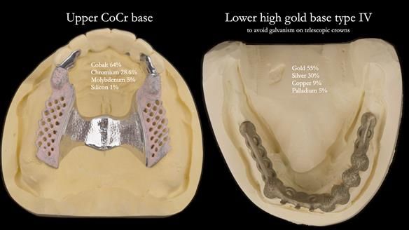 Newsletter 76: Jackie’s case – Telescopic overdenture & precision RPD (the tricky truth!)