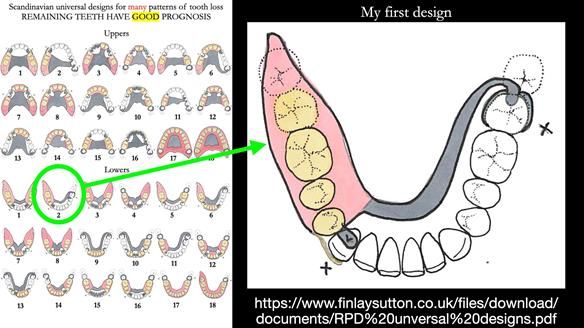 Finlay's Newsletter 61 provision of a lower unilateral free end saddle metal based partial denture for Joyce