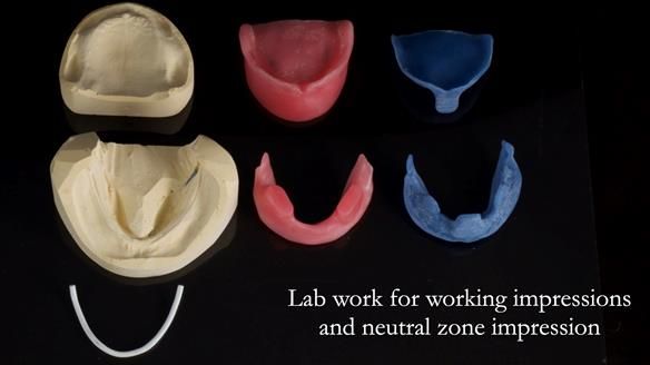 Newsletter 83: Sheila’s Complete Denture Success