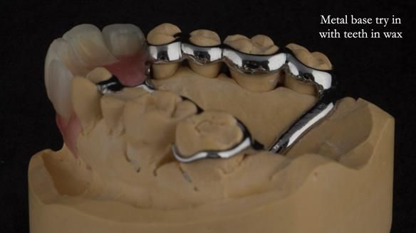 Finlay's Newsletter 63 Case study provision of metal based Scandinavian RPD - functional 10 years on