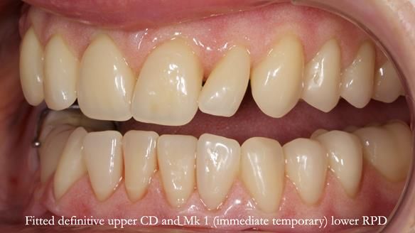 Newsletter 82 Mary - A complete upper and a one-tooth gasket denture
