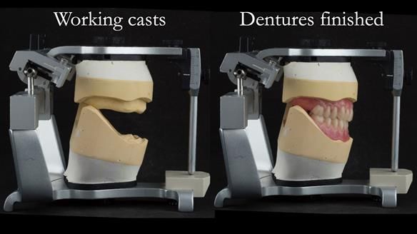 Newsletter 75: Marion’s case - Step-by-step complete denture workflow