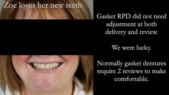 Finlay's Newsletter 58 Gasket upper partial denture for Zoe