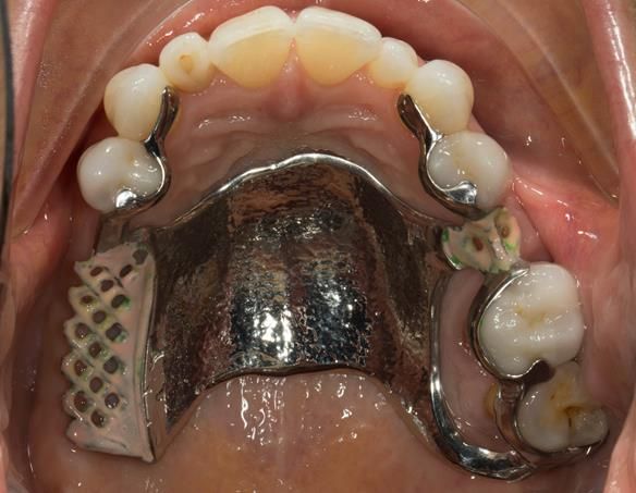 Figure 73 Cobalt chromium framework trial insertion, checking the fit onto the natural teeth and soft tissues