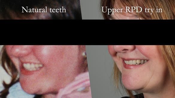 Finlay's Newsletter 58 Gasket upper partial denture for Zoe
