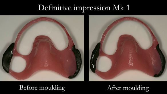 Figure 16 Definitive impression - border moulding with greenstick compound