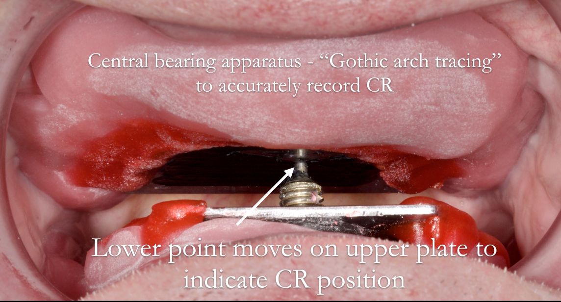 The most reproducible and reliable way of finding centric relation is by using a central bearing apparatus