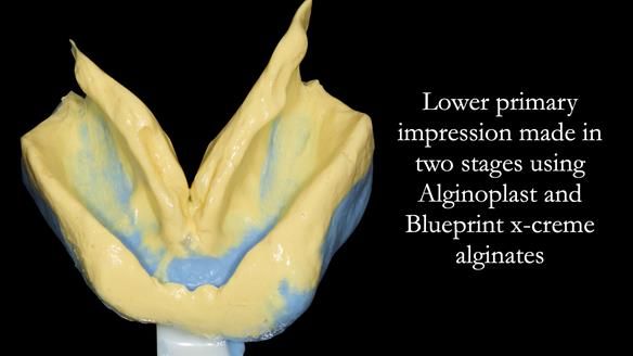 Newsletter 53 showing the making and fitting of ultra life-like dentures for Valena