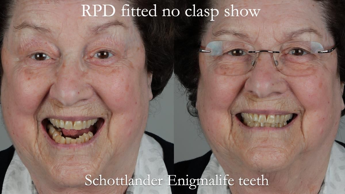 Finlay's Newsletter 60 Sylvia's upper Kennedy Class 2 Mod 1 metal based upper RPD