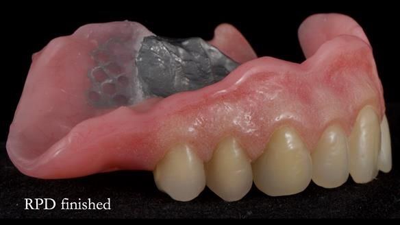 Newsletter 55 Provision of metal based partial dentures for Zephyrine with a repaired cleft lip and palate