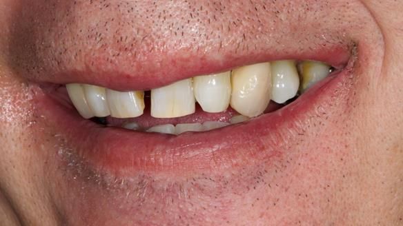 Newsletter 86 Peter the Architect — precision removable partial dentures case study
