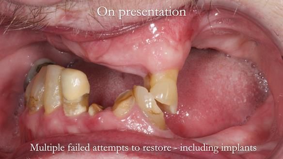 Newsletter 55 Provision of metal based partial dentures for Zephyrine with a repaired cleft lip and palate