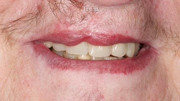 Newsletter 55 Provision of metal based partial dentures for Zephyrine with a repaired cleft lip and palate