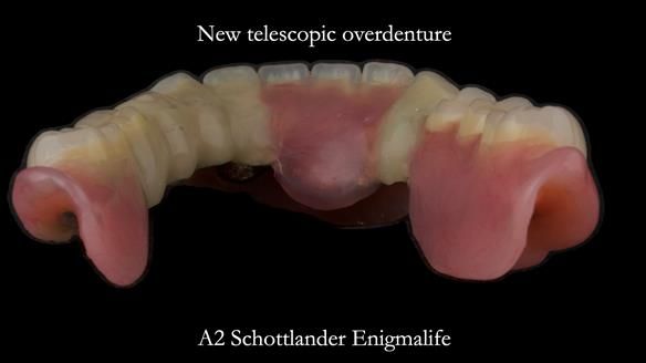 Newsletter 76: Jackie’s case – Telescopic overdenture & precision RPD (the tricky truth!)