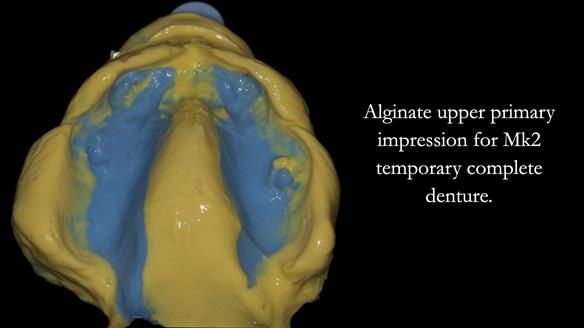 Newsletter 77: Jeremy’s case – immediate complete upper denture