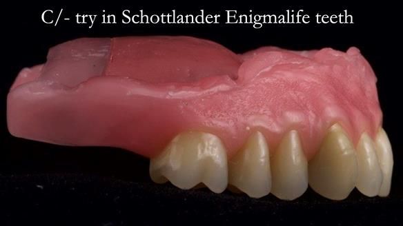 Newsletter 54 case presentation upper complete denture and lower Scandinavian designed hygienic partial denture for David