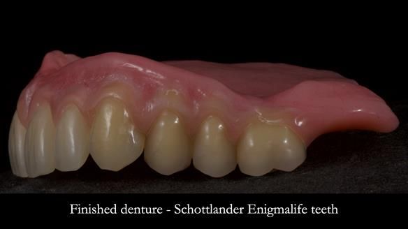 Newsletter 83: Sheila’s Complete Denture Success