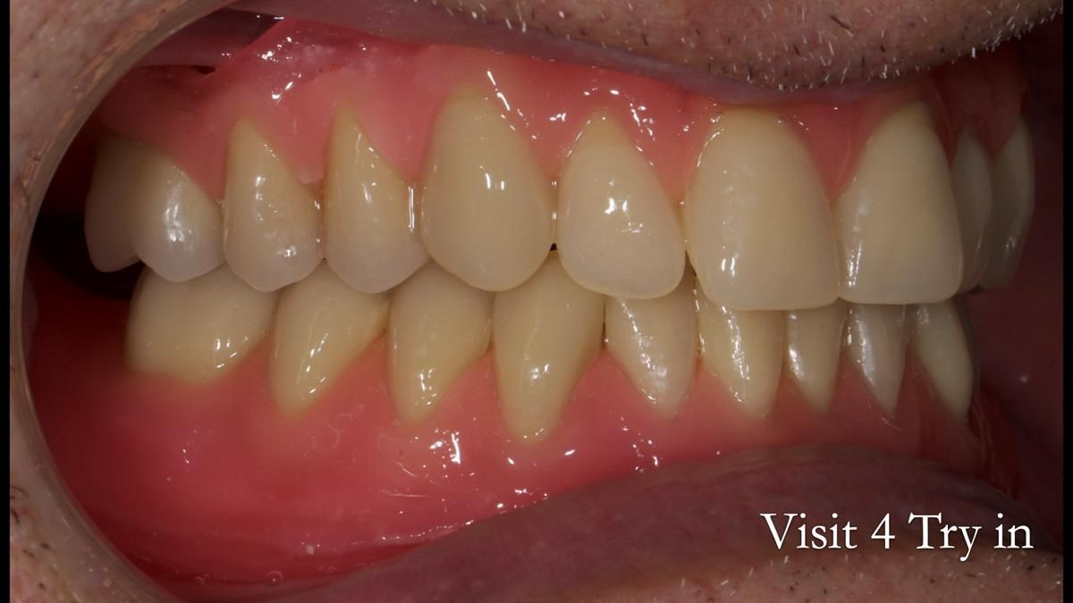 Fin’s Newsletter 88 — Complete dentures - full protocol… he rearranged his own teeth!
