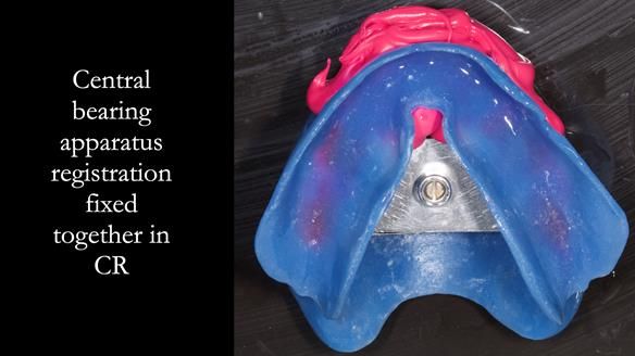 Newsletter 53 showing the making and fitting of ultra life-like dentures for Valena