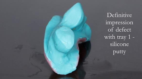 Upper metal base partial denture/occlusal stabilisation splint/obturator - full protocol